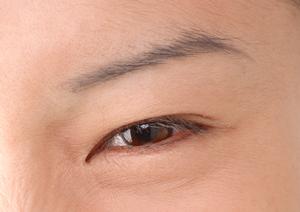 【2025年最新】赤ら顔の悩み解消！大阪で効果的な対策法と治療ガイド